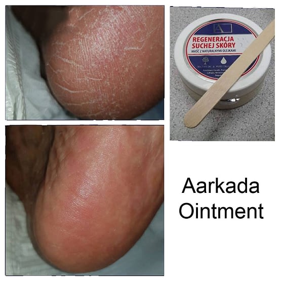 Skin Ointment – Antibacterial, Anti-fungal, Moisturizing Cream for Nails, Feet, Hands, Elbows